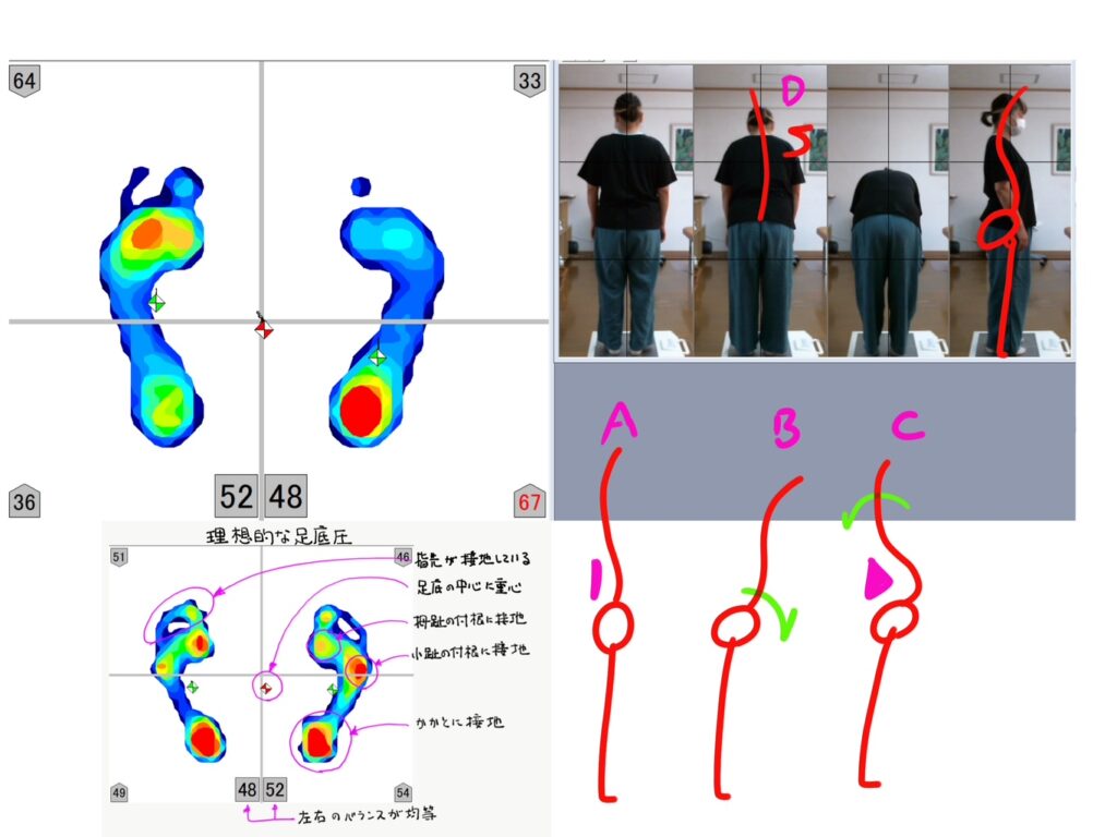 椎間板ヘルニア改善例1