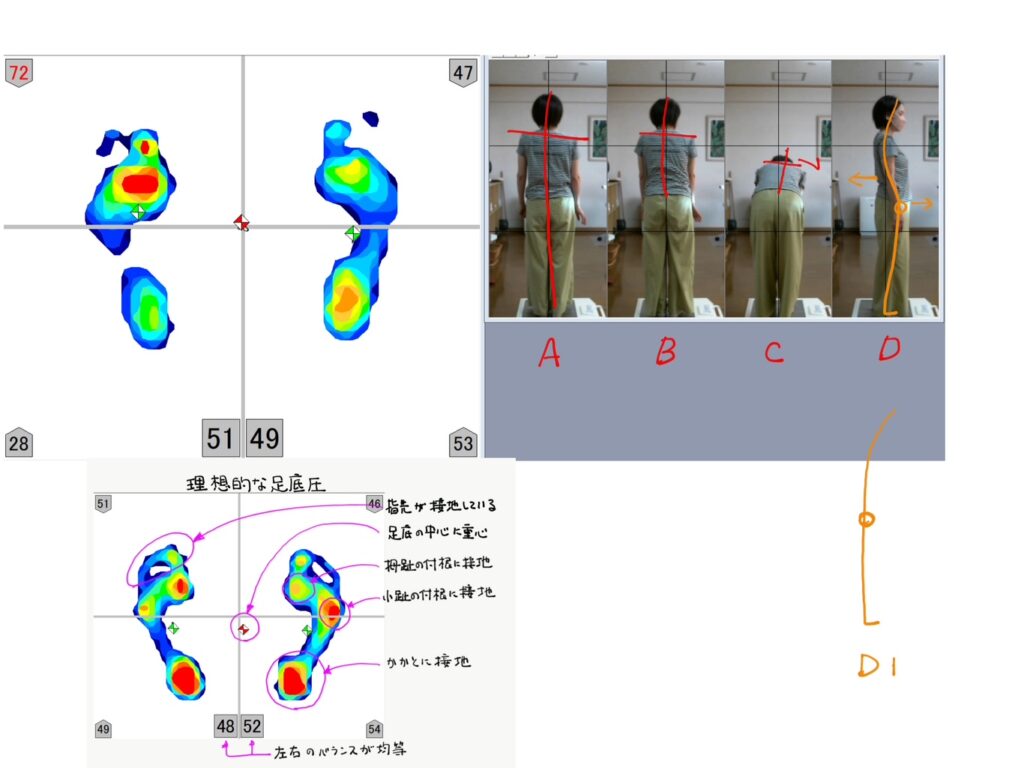 手のしびれだるさ施術前