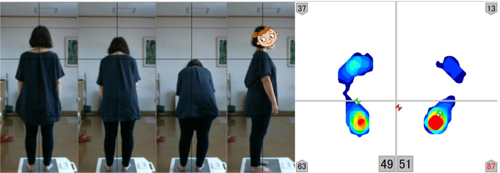 腱鞘炎を治すために整体で姿勢検査をする