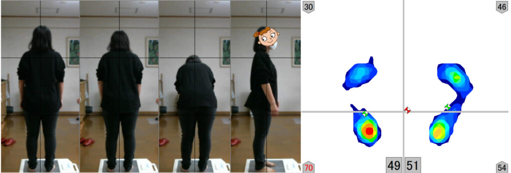 腱鞘炎を治すために整骨院で姿勢検査をする
